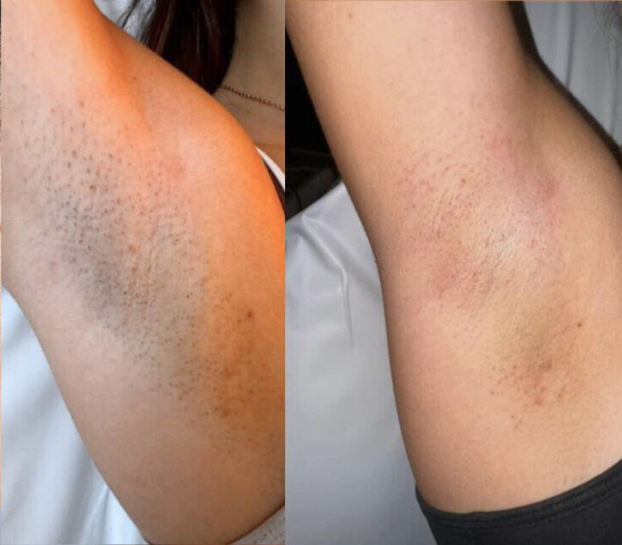 Laser Haarentfernung vorher-nachher